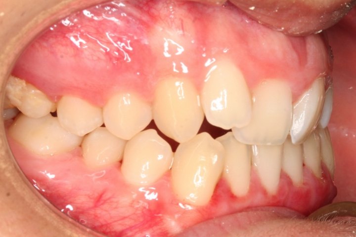 Vista lateral antes del tratamiento: falta de espacio y dientes desalineados