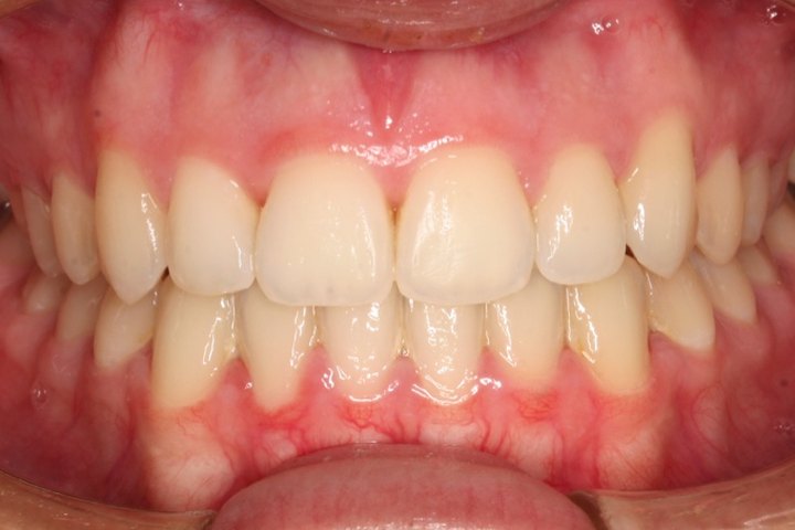 Vista frontal al terminar el tratamiento: los dientes superiores e inferiores alineados y en contacto correcto