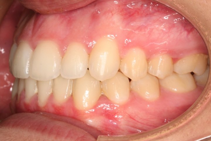 Vista lateral al terminar el tratamiento: los dientes encajan correctamente al morder
