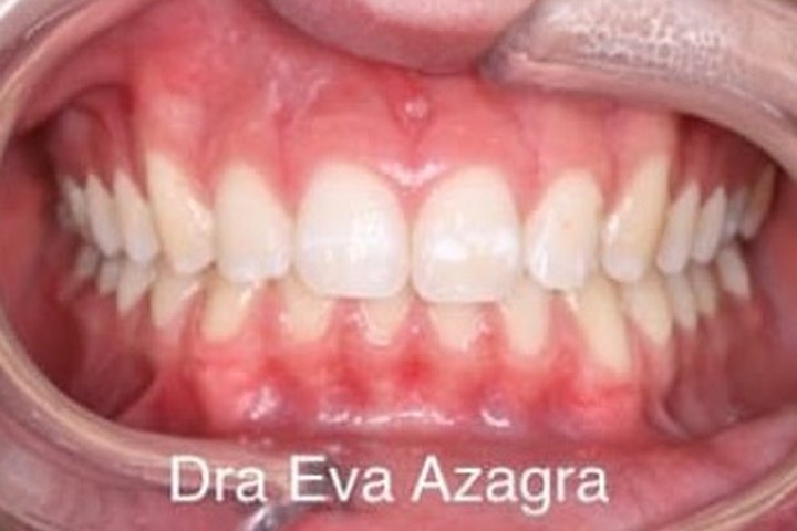 Vista frontal en la revisión, cinco años después de retirar la ortodoncia: los dientes siguen alineados