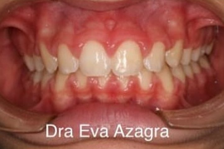 Vista frontal al terminar el tratamiento, en 2015: dientes alineados y mordida corregida
