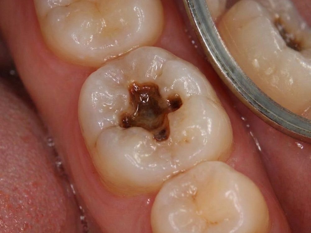 Caries profunda en un molar vista con espejo intraoral