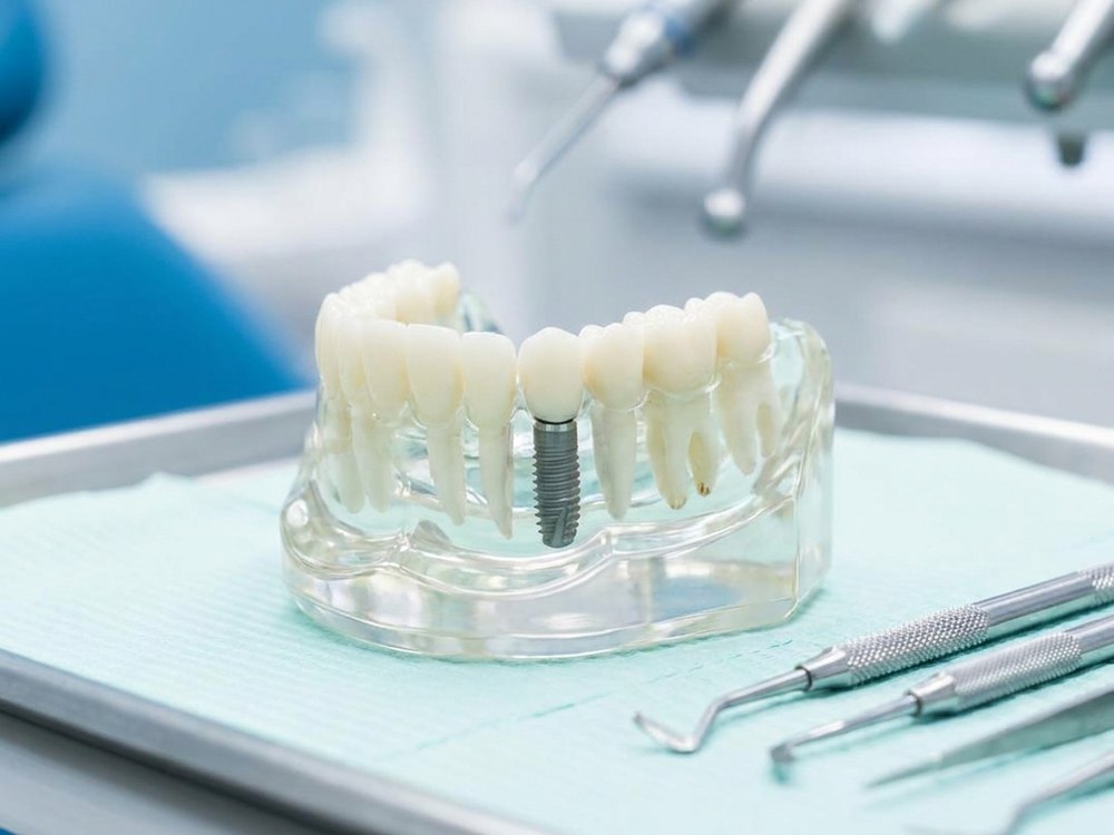 Modelo de implante dental colocado en la arcada, sobre la bandeja de instrumental
